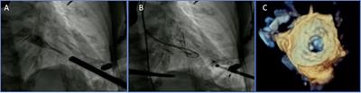 Challenges and Open Issues in Transcatheter Mitral Valve Implantation: Smooth Seas Do Not Make Skillful Sailors